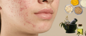 Treat Acne Naturally with Ayurvedic Remedies